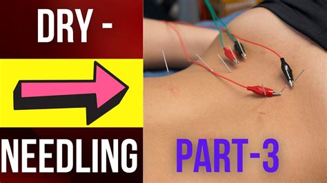 Dry Needling With Electric Stimulation Dryneedling Rehab Muscle