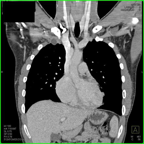 Abscess Right Chest Wall Extends Into Muscle And Vascularity Chest