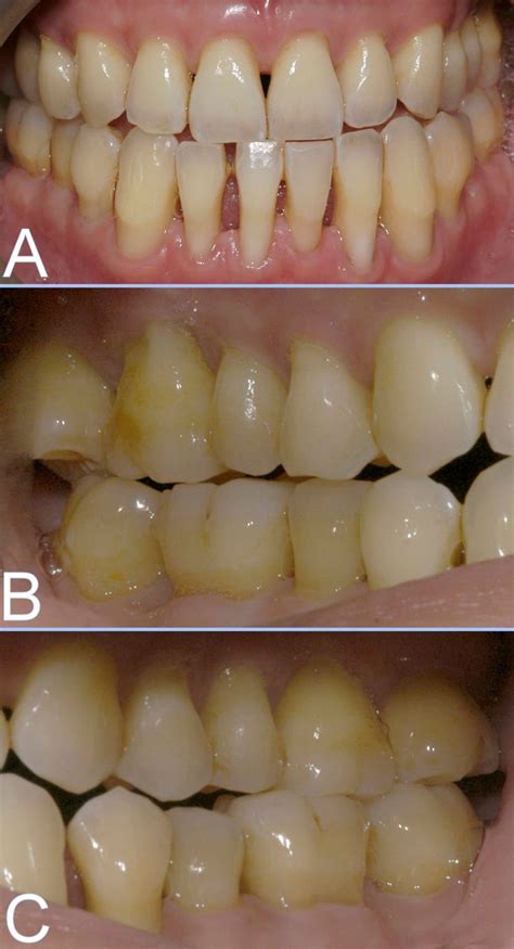 Post Orthognathic Surgery Post Orthodontic Occlusal Adjustment