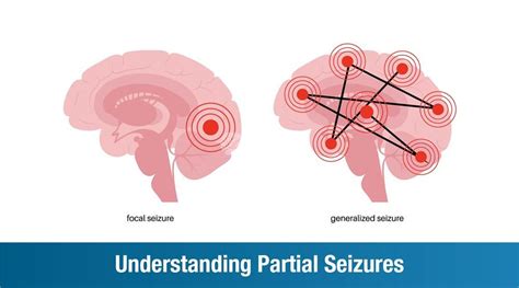 Understanding Partial Seizures: Types, Symptoms, Causes & Treatment ...