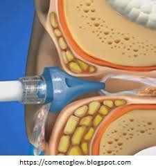 5 Simple Methods To Safely Clear Your Clogged Ears At Home