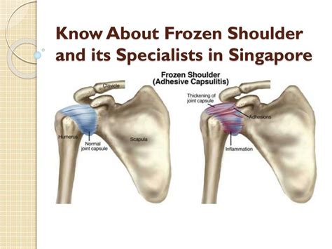 PPT Know About Frozen Shoulder And Its Specialists In Singapore