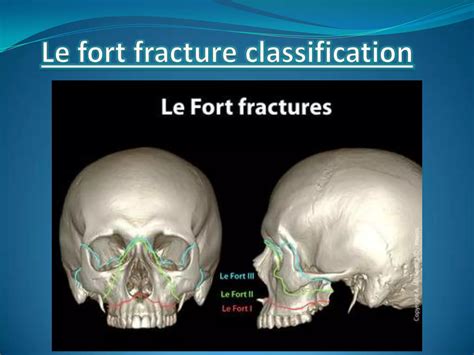 Le fort fracture(2) | PPTX