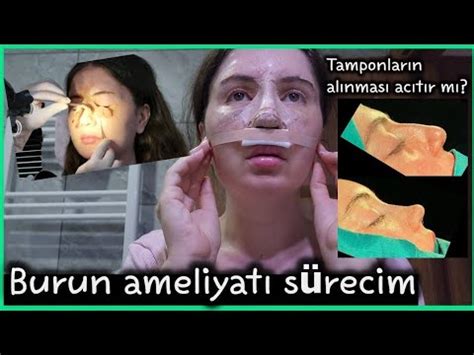 Burun ameliyatı sürecim Ameliyat öncesi ve sonrası Tamponlar