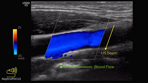 Basics Of Doppler Ultrasound For The Nephrologist Part Renal