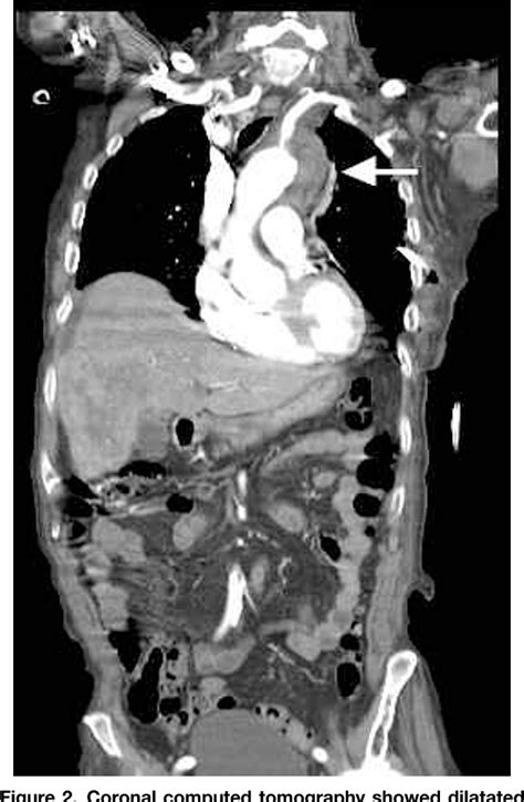 Aortic Intramural Hematoma Stanford Type A Semantic Scholar