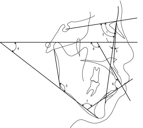 Angular Measurements 1 Sna Angle 2 Snb Angle 3 Anb Angle 4 Download Scientific Diagram