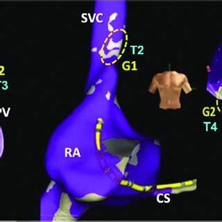 Fractionation Mapping Electroanatomical Model Showing Fractionation