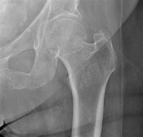 Femoral Neck Fracture X Ray Perybrilliant