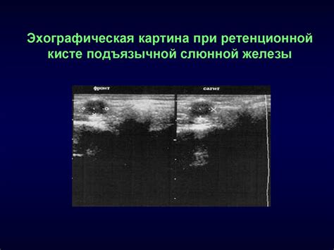 Слюннокаменная болезнь у детей. Ретенционные кисты малых и больших ...