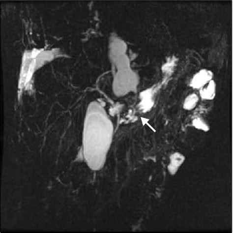 Magnetic Resonance Cholangiopancreatography Revealed A Stenosis Arrow Download Scientific