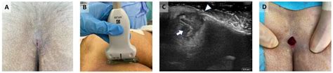 Infected Pilonidal Cyst A Natal Cleft With Small Opening B Using