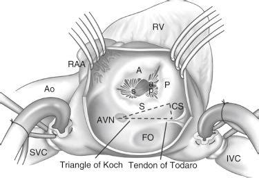 Percutaneous Tricuspid Valve Repair - Clinical Tree