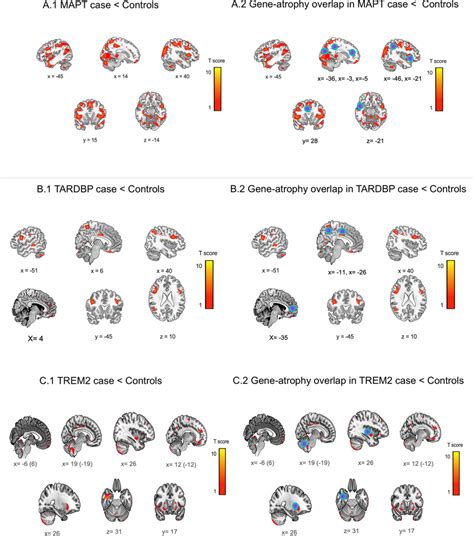 Comparisons Of Atrophy And Gene Atrophy Overlap In Gr Patients And