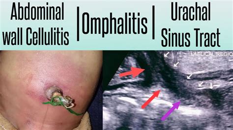 Warning Sign In Babies Omphalitis Abdominal Wall Cellulitis In