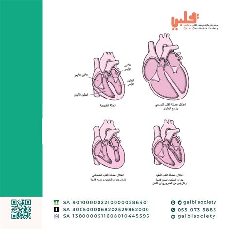 Cardiomyopathy