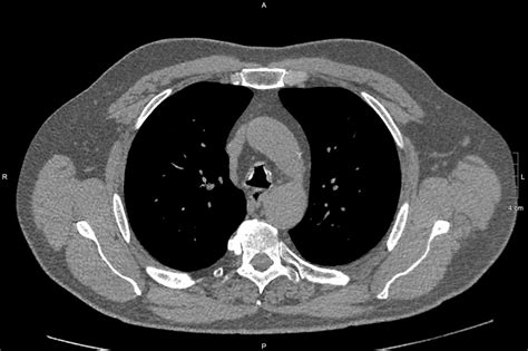 Diffuse Tracheal Narrowing Pacs