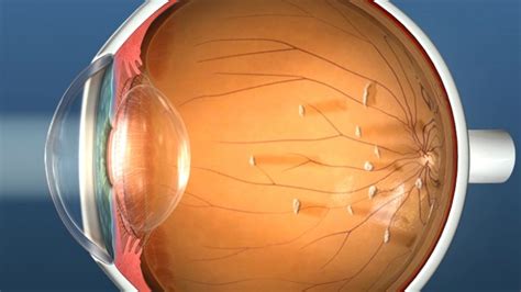 Vitrectomy Eye Surgery For Floaters Retina Doctor Melbourne