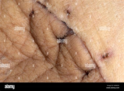 Scar On Left Inner Thigh From Operation To Remove A High Grade Soft Tissue Sarcoma On Female