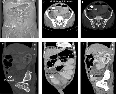 Images Of CECT Abdomen Showing Small Bowel Obstruction With