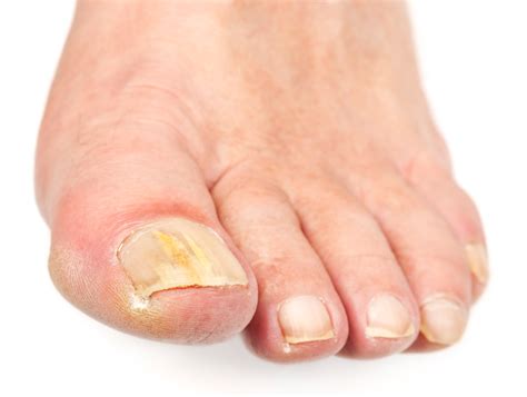 Toe Infections Pictures Pictures Photos