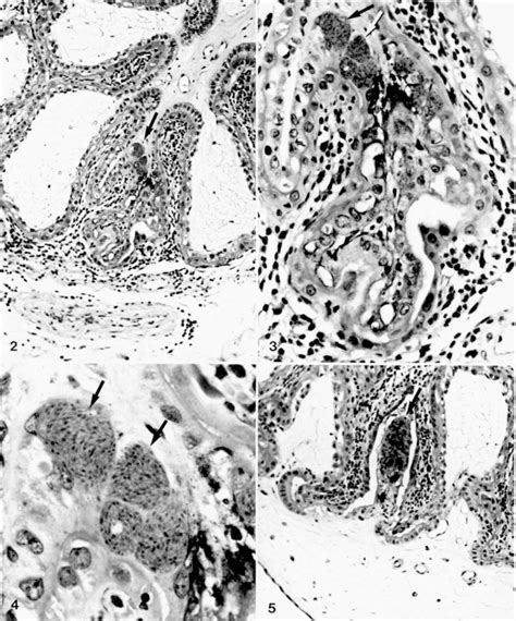 Placenta Fetus No Intracellular Toxoplusmu Arrow In