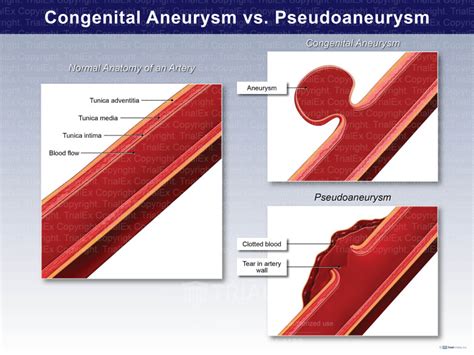 Congential Aneurysm vs Pseudoaneurysm - TrialExhibits Inc.