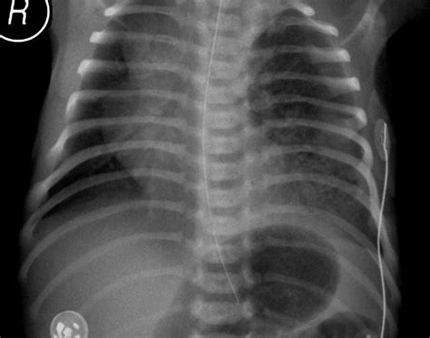 Congenital Pulmonary Airway Malformation Cpam Pacs