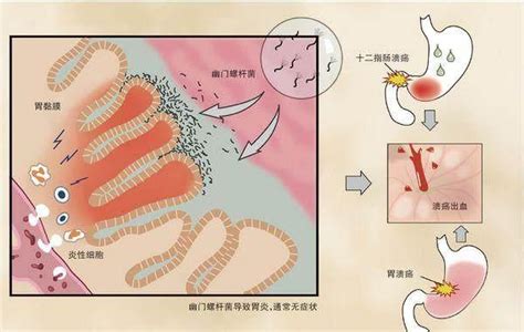 幽門螺旋桿菌感染，真的會導致胃癌嗎？ 每日頭條