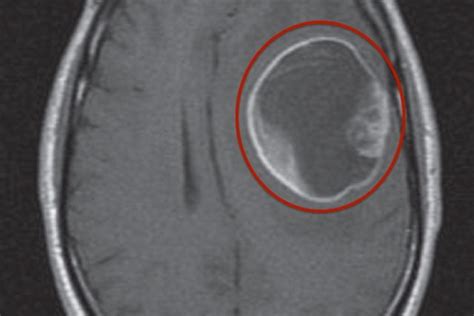 Tumor cerebral principais tipos e como é feito o tratamento Tua Saúde