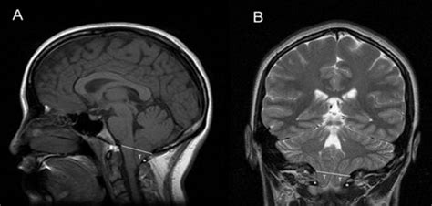 Sex Differences Identified In Deadly Brain Tumours