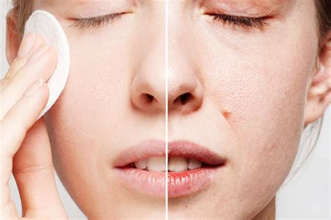 How To Get Rid Of Enlarged Pores Naturally At Home