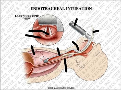 Lecture 3 3 Endotracheal Intubation Diagram Quizlet