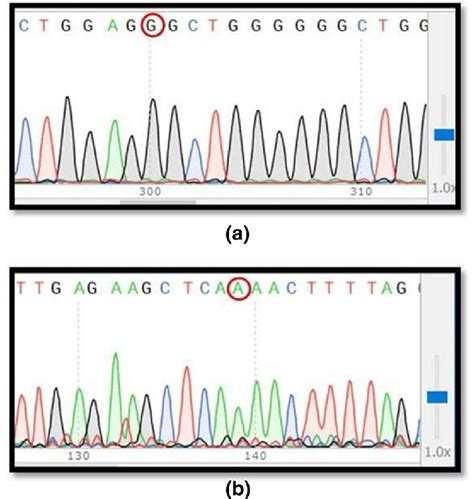 Sanger Sequencing Electropherograms With Novel Mutations In A Exon 5 Of