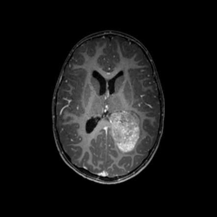 Atypical Choroid Plexus Papilloma Radiology Reference Article