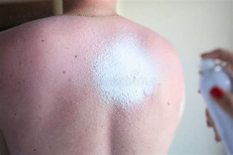 Apply Sunburn Cream On A Man`s Burned Back Stock Image Image Of