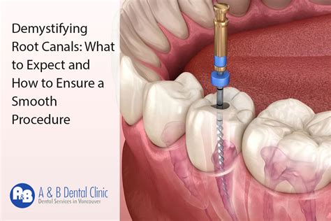 Demystifying Root Canals What To Expect And How To Ensure A Smooth