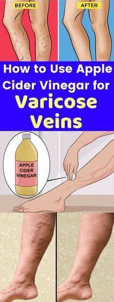 How To Use Apple Cider Vinegar For Varicose Veins Lizy Style