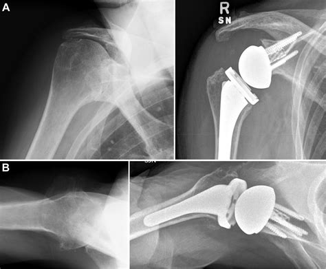 Clinical And Radiographic Outcomes With A Posteriorly Augmented Glenoid