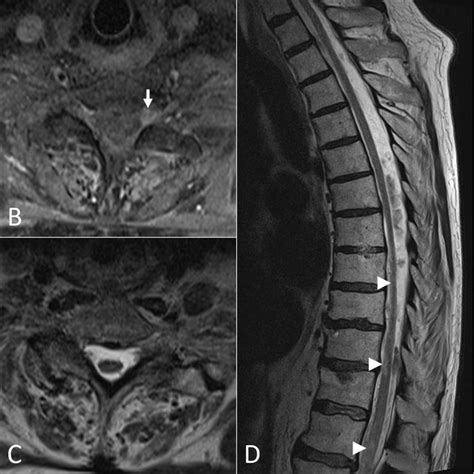 Mri Cervical And Thoracic Spine Sagittal T1 Weighted Fat Saturated