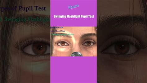 Pupil Examination Rapd Pupillary Light Reflex Marcus Gunn Pupil