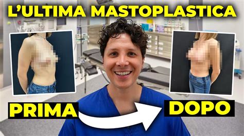 Mastoplastica Additiva Con Il Dott Maestrini Prima E Dopo Youtube