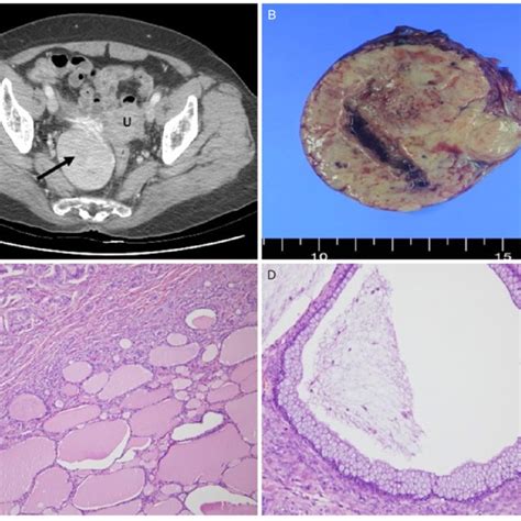 A Contrast Enhanced Computed Tomography Shows A Well Defined