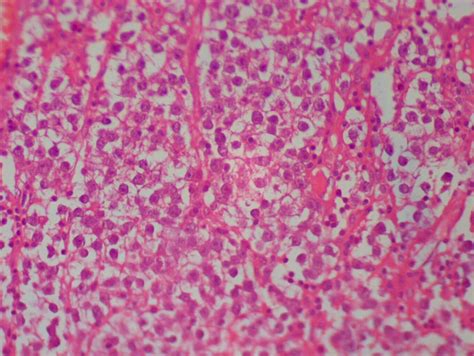 Spontaneous Rupture Of Seminoma In Undescended Testis With