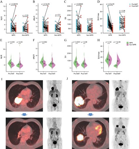 Distribution Of 18 F Fdg Pet Ct Metabolic Parameters And Inflammatory