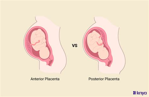 Anterior And Posterior Placenta Exploring Key Differences Knya