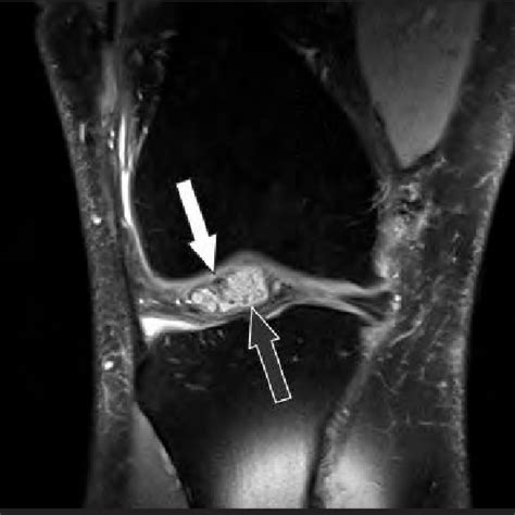 PDF MRI Findings Of Cyclops Lesions Of The Knee