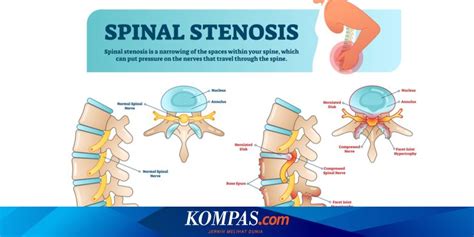 Penyakit Stenosis Spinal Tulang Belakang Gejala Penyebab