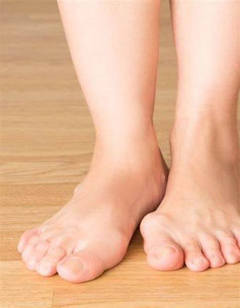 Bone Spur On Side Of Foot Pictures On Sale