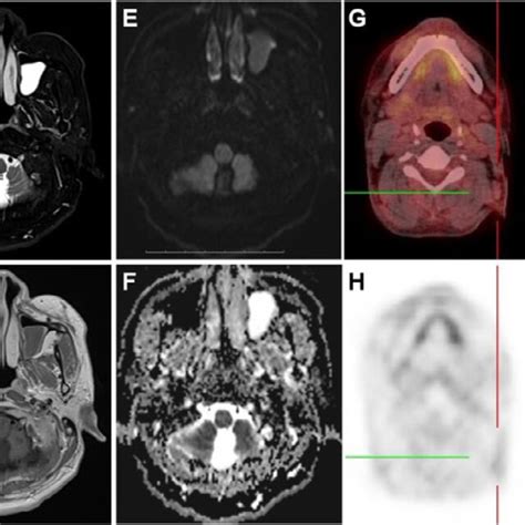 Nasopharyngeal Ct Scan Nasopharyngoscopy And Microscopic Views Of Download Scientific Diagram